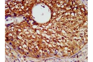 IHC image of ABIN7169341 diluted at 1:600 and staining in paraffin-embedded human cervical cancer performed on a Leica BondTM system. (SERPINB4 Antikörper  (AA 128-208))