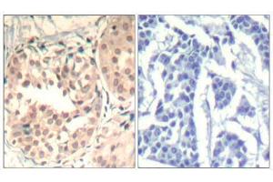 Immunohistochemical analysis of paraffin-embedded human breast carcinoma tissue using CDK6 (phospho-Tyr13) Antibody (E011542).