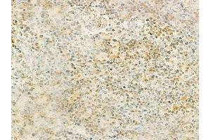 ABIN6264976 and ABIN6278525 at 1/100 staining human colon carcinoma by IHC-P.