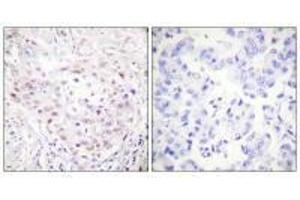 Immunohistochemistry analysis of paraffin-embedded human breast carcinoma tissue, using SENP3 antibody. (SENP3 Antikörper)