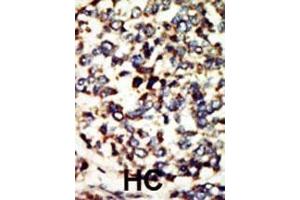 Formalin-fixed and paraffin-embedded human cancer tissue reacted with the primary antibody, which was peroxidase-conjugated to the secondary antibody, followed by DAB staining. (NEK7 Antikörper  (N-Term))