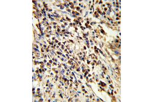 Formalin-fixed and paraffin-embedded human lung carcinoma reacted with PSMA7 Antibody , which was peroxidase-conjugated to the secondary antibody, followed by DAB staining. (PSMA7 Antikörper  (AA 100-126))
