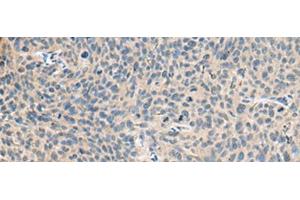 Immunohistochemistry of paraffin-embedded Human cervical cancer tissue using RNASE1 Polyclonal Antibody at dilution of 1:50(x200) (RNASE1 Antikörper)