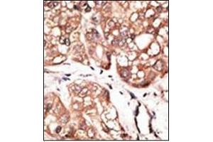 Formalin-fixed and paraffin-embedded human cancer tissue reacted with the primary antibody, which was peroxidase-conjugated to the secondary antibody, followed by AEC staining. (ATG4D Antikörper  (AA 227-257))