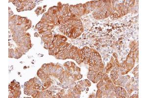IHC-P Image Immunohistochemical analysis of paraffin-embedded human lung SCC, using Dishevelled 2, antibody at 1:100 dilution. (DVL2 Antikörper  (Internal Region))