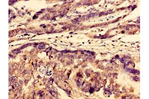 Immunohistochemistry of paraffin-embedded human gastric cancer using ABIN7175699 at dilution of 1:100
