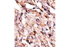 Formalin-fixed and paraffin-embedded human cancer tissue reacted with the primary antibody, which was peroxidase-conjugated to the secondary antibody, followed by AEC staining. (BCKDK Antikörper  (Middle Region))