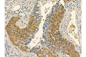 BCL7C Mouse Monoclonal Antibody at 1/100 staining human lung cancer and adjacent non-tumor tissue by IHC-P. (BCL7C Antikörper  (Internal Region))