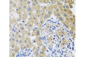 Immunohistochemistry of paraffin-embedded Human liver damage using RHOB Polyclonal Antibody at dilution of 1:100 (40x lens).