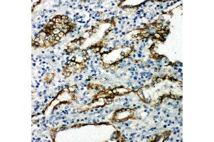 Anti-Aquaporin 4 antibody, IHC(P) IHC(P): Human Lung Cancer Tissue