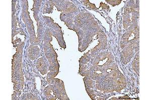 IHC analysis of MUC1 using anti-MUC1 antibody (ABIN7602711). (MUC1 Antikörper  (AA 979-1095))