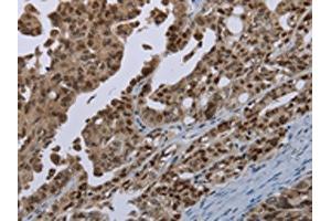 The image on the left is immunohistochemistry of paraffin-embedded Human ovarian cancer tissue using ABIN7191347(MAGEB18 Antibody) at dilution 1/20, on the right is treated with synthetic peptide. (MAGEB18 Antikörper)