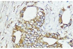Immunohistochemistry of paraffin-embedded Human lung cancer using SOCS6 Polyclonal Antibody at dilution of 1:100 (40x lens). (SOCS6 Antikörper)
