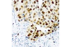 Immunohistochemical analysis of DDX39B staining in human prostate cancer formalin fixed paraffin embedded tissue section.