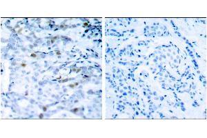 Immunohistochemical analysis of paraffin-embedded breast carcinoma, using CDC2(Phospho-Thr161) Antibody. (CDK1 Antikörper  (pThr161))