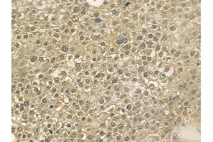ABIN6266101 and ABIN6273351 at 1/100 staining human hepatocellular carcinoma by IHC-P. (ZFYVE16 Antikörper  (C-Term))