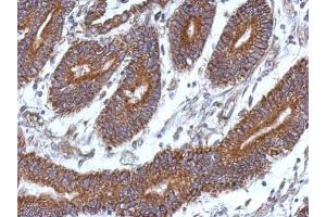 IHC-P Image Immunohistochemical analysis of paraffin-embedded human colon carcinoma, using CCDC37, antibody at 1:500 dilution. (CCDC37 Antikörper  (N-Term))