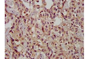 IHC image of  diluted at 1:1200 and staining in paraffin-embedded human liver cancer performed on a Leica BondTM system. (CD133 Antikörper  (AA 508-792))