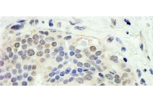 Immunohistochemistry (IHC) image for anti-E2F Transcription Factor 1 (E2F1) (AA 300-350) antibody (ABIN7454373)