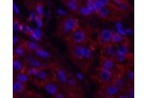 Immunofluorescence analysis of Human stomach cancer tissue using Catenin beta Monoclonal Antibody at dilution of 1:200. (beta Catenin Antikörper)