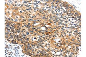 The image on the left is immunohistochemistry of paraffin-embedded Human esophagus cancer tissue using ABIN7127958(CENPM Antibody) at dilution 1/30, on the right is treated with fusion protein. (CENPM Antikörper)