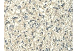 Detection of ALDH1A2 in Human Glioma Tissue using Polyclonal Antibody to Aldehyde Dehydrogenase 1 Family, Member A2 (ALDH1A2)