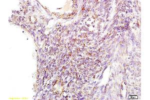 Formalin-fixed and paraffin embedded human cervical carcinoma tissue labeled with Anti GNPAT Polyclonal Antibody, Unconjugated (ABIN709106) at 1:100 followed by conjugation to the secondary antibody and DAB staining. (GNPAT Antikörper  (AA 201-300))