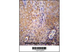 SLC6A14 Antibody immunohistochemistry analysis in formalin fixed and paraffin embedded human esophageal carcinoma followed by peroxidase conjugation of the secondary antibody and DAB staining. (Slc6a14 Antikörper  (C-Term))
