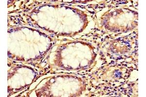 Immunohistochemistry of paraffin-embedded human colon cancer using ABIN7164582 at dilution of 1:100 (C12orf65 Antikörper  (AA 36-166))