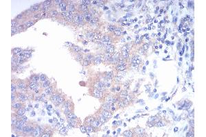 Immunohistochemical analysis of paraffin-embedded endometrial cancer tissues using FGFR3 mouse mAb with DAB staining. (FGFR3 Antikörper  (AA 529-694))