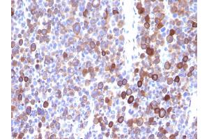 Formalin-fixed, paraffin-embedded human Melanoma stained with Moesin Mouse Monoclonal Antibody (MSN/491). (Moesin Antikörper)
