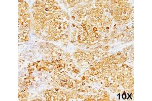 Formalin/paraffin human melanoma stained with MART-1 / Melan-A antibody (M2-9E3). (MLANA Antikörper)