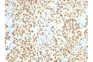 Formalin-fixed, paraffin-embedded human Melanoma stained with SOX10 Monoclonal Antibody (SPM607). (SOX10 Antikörper  (AA 115-269))