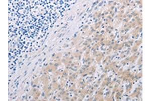 The image on the left is immunohistochemistry of paraffin-embedded Human liver cancer tissue using ABIN7191852(PFN2 Antibody) at dilution 1/30, on the right is treated with synthetic peptide. (PFN2 Antikörper)