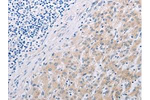 The image on the left is immunohistochemistry of paraffin-embedded Human liver cancer tissue using ABIN7191852(PFN2 Antibody) at dilution 1/30, on the right is treated with synthetic peptide.