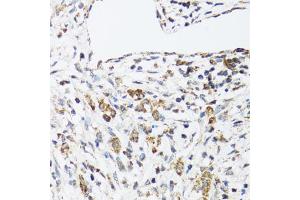 Immunohistochemistry of paraffin-embedded human uterine cancer using DHRS2 antibody (ABIN5973846) at dilution of 1/100 (40x lens). (DHRS2 Antikörper)