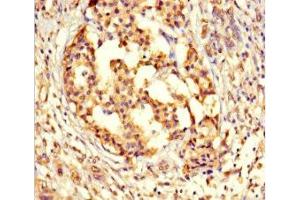 Immunohistochemistry of paraffin-embedded human pancreatic cancer using ABIN7164529 at dilution of 1:100 (GPX8 Antikörper  (AA 41-209))