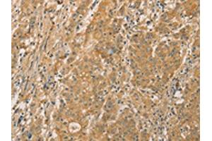 The image on the left is immunohistochemistry of paraffin-embedded Human gastic cancer tissue using ABIN7131118(SNAP91 Antibody) at dilution 1/20, on the right is treated with fusion protein. (SNAP91 Antikörper)