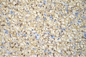 Immunohistochemistry was performed on paraffin-embedded human renal carcinoma using PPM1G antibody (ABIN7800035), 1:200). (Rekombinanter PPM1G Antikörper)