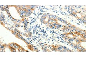 Immunohistochemistry of paraffin-embedded Human gasrtic cancer tissue using TRPA1 Polyclonal Antibody at dilution 1:60 (TRPA1 Antikörper)