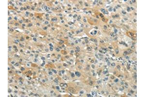 The image on the left is immunohistochemistry of paraffin-embedded Human liver cancer tissue using ABIN7193074(XKR3 Antibody) at dilution 1/20, on the right is treated with synthetic peptide. (XKR3 Antikörper)