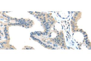 Immunohistochemistry of paraffin-embedded Human thyroid cancer tissue using VPS36 Polyclonal Antibody at dilution 1:40 (VPS36 Antikörper)