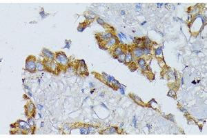 Immunohistochemistry of paraffin-embedded Human lung cancer using ACADL Polyclonal Antibody at dilution of 1:100 (40x lens). (ACADL Antikörper)