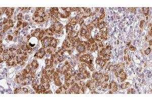 ABIN6278960 at 1/100 staining Human liver cancer tissue by IHC-P.