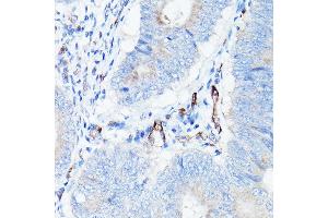 Immunohistochemistry of paraffin-embedded human colon carcinoma using CDH5 Rabbit pAb (ABIN6134029, ABIN6138297, ABIN6138298 and ABIN6216033) at dilution of 1:150 (40x lens). (Cadherin 5 Antikörper  (AA 650-750))