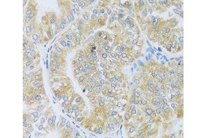 Immunohistochemistry of paraffin-embedded Human uterine cancer using ASB4 Polyclonal Antibody at dilution of 1:100 (40x lens). (ASB4 Antikörper)