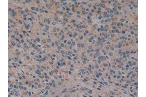 DAB staining on IHC-P; Samples: Human Prostate cancer Tissue (GP2 Antikörper  (AA 307-512))