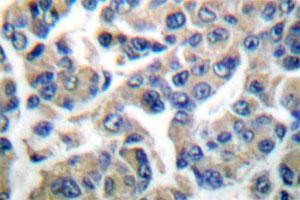 Immunohistochemical analysis of EEF2K polyclonal antibody  in paraffin-embedded human breast carcinoma tissue.
