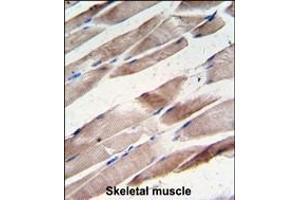 Formalin-fixed and paraffin-embedded human hepatocarcinoma tissue reacted with the primary antibody, which was peroxidase-conjugated to the secondary antibody, followed by DAB staining. (Desmin Antikörper  (AA 1-30))