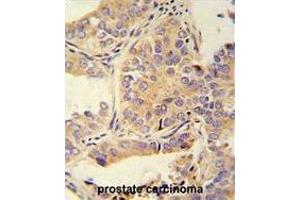 UBA52 antibody (C-Term) immunohistochemistry analysis in formalin fixed and paraffin embedded human prostate carcinoma followed by peroxidase conjugation of the secondary antibody and DAB staining.